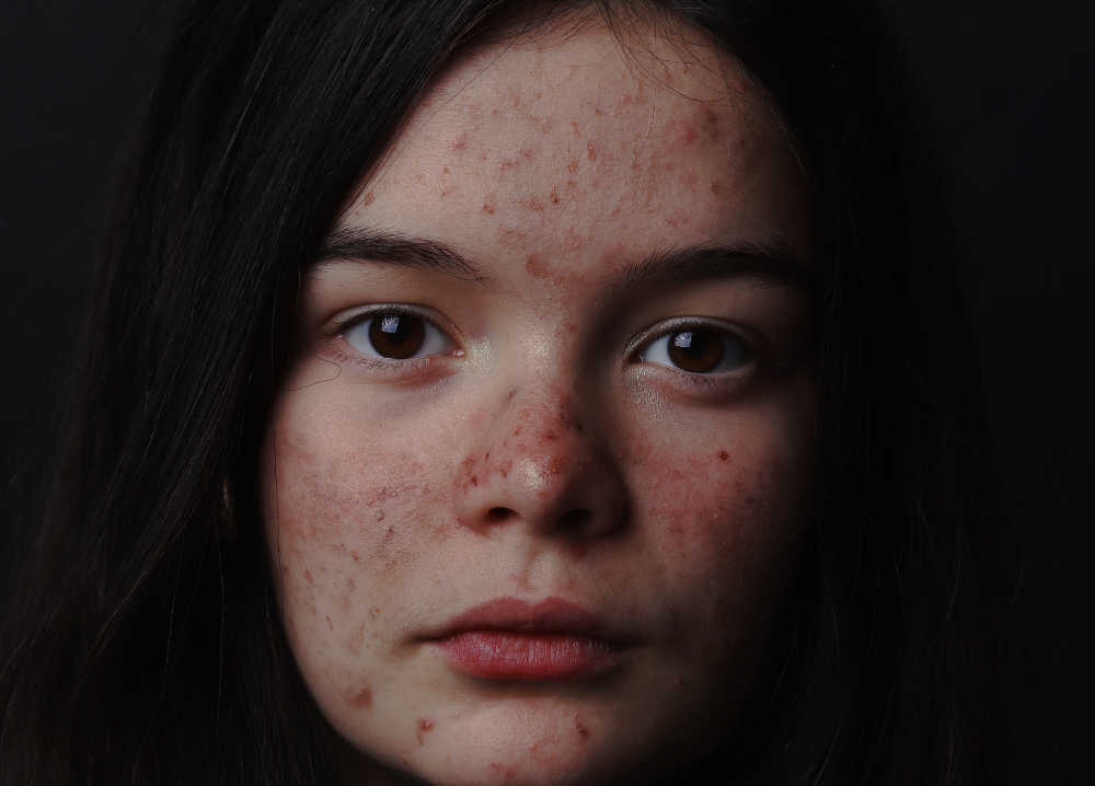 rinomodelacion valencia: la rinoplastia liquida sin cirugia